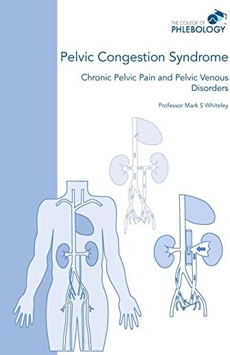 Pelvic Congestion Syndrome - Chronic Pelvic Pain and Pelvic Venous Disorders